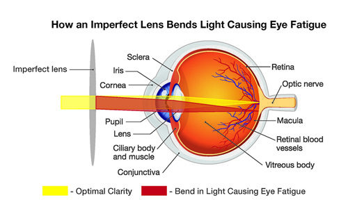 BrandX_Graphic_How-an-Imperfect-Lens-Bends-Light-Causing-Eye-Fatigue.jpg