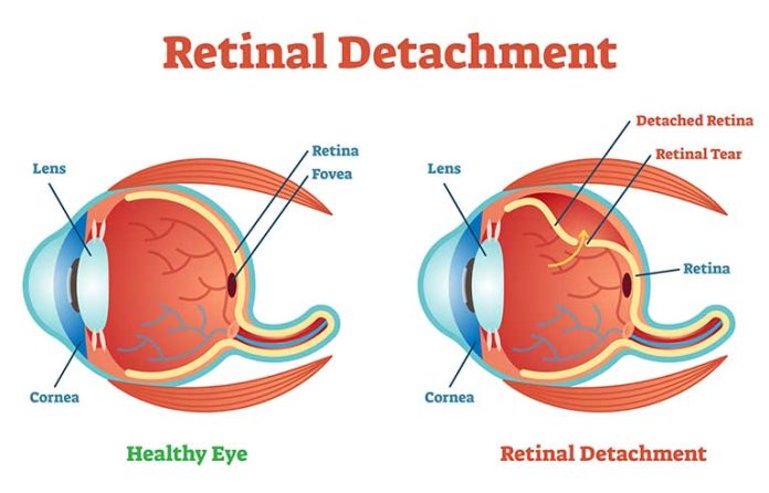 retina