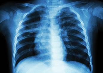 tuberculosis