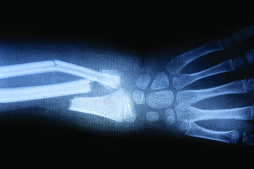 xray-fracture.jpg